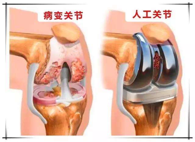 手术摘除与人工膝关节置换治疗骨质增生骨刺的优缺点