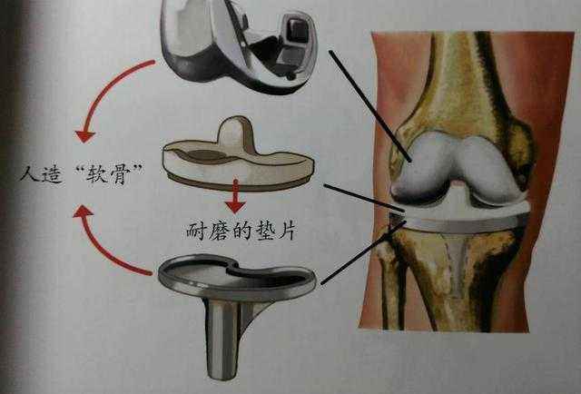 手术摘除与人工膝关节置换治疗骨质增生骨刺的优缺点