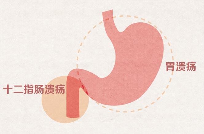 消化性溃疡禁用家传骨方特效药酒治疗腰颈椎间盘突出和骨质增生